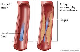 The comparison between a normal artery and one narrowed by atherosclerotic plaque